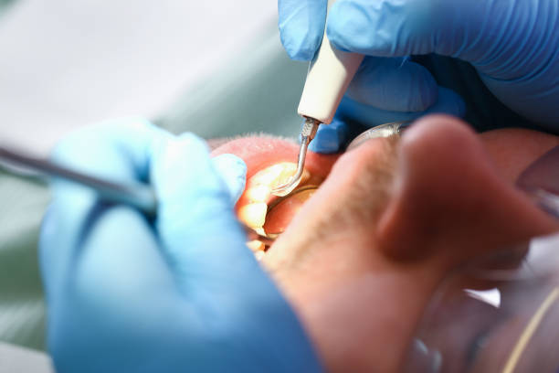 Best Emergency Dental Care for Broken or Chipped Teeth in Alpharetta, GA